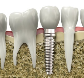 Dental-Implants