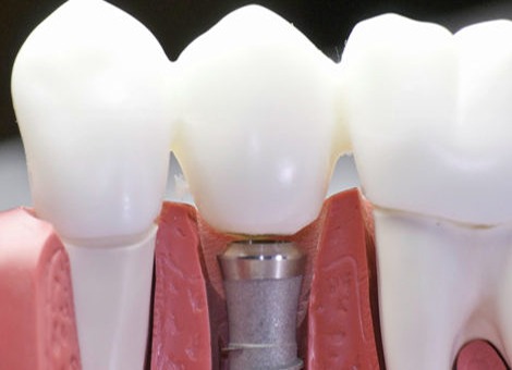 Dental_Implants-2 Dental-Implants