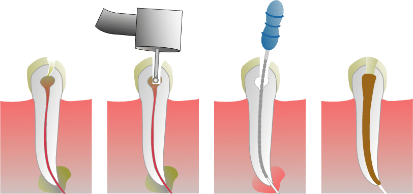 Root-Canal Root-Canal