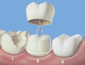 crown2 Cheap Crowns Dental