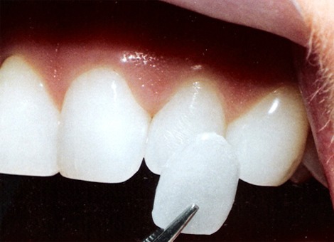 veeners Dental Veneers